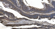 IHC staining of FFPE human rectal cancer with EPRS antibody. HIER: boil tissue sections in pH8 EDTA for 20 min and allow to cool before testing.