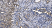 IHC staining of FFPE human gallbladder adenocarcinoma tissue with EPRS antibody. HIER: boil tissue sections in pH8 EDTA for 20 min and allow to cool before testing.