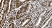 Ku70 Antibody Rectal Cancer IHC. Immunohistochemistry staining of FFPE human rectal cancer tissue with Ku70 antibody. HIER: boil tissue sections in pH8 EDTA for 20 min and allow to cool before testing.
