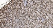 Ku70/XRCC6 Antibody Adrenocortical Adenoma IHC. Immunohistochemistry analysis of FFPE human adrenocortical adenoma tissue stained with Ku70/XRCC6 Antibody demonstrates strong diffuse nuclear HRP-DAB brown staining throughout neoplastic adrenal cortical cell populations, consistent with XRCC6 / Ku70-associated DNA damage response pathway expression. This DNA end binding protein antibody highlights non-homologous end joining-associated repair signaling and genomic stability regulation within adrenal tumor tissue. HIER: boil tissue sections in pH8 EDTA for 20 min and allow to cool before testing.