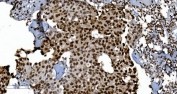 Ku70/XRCC6 Antibody Breast Cancer IHC. Immunohistochemistry analysis of FFPE human breast cancer tissue stained with Ku70/XRCC6 Antibody demonstrates strong diffuse nuclear HRP-DAB brown staining throughout malignant epithelial tumor cell populations, consistent with XRCC6 / Ku70-associated DNA damage response pathway expression. This DNA end binding protein antibody highlights non-homologous end joining-associated repair signaling and genomic stability regulation within breast carcinoma tissue. HIER: boil tissue sections in pH8 EDTA for 20 min and allow to cool before testing.