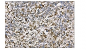 IHC staining of FFPE human liver cancer tissue with MerTK antibody. HIER: boil tissue sections in pH8 EDTA for 20 min and allow to cool before testing.