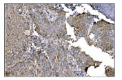 IHC staining of FFPE human lung cancer tissue with Ornithine Aminotransferase antibody. HIER: boil tissue sections in pH8 EDTA for 20 min and allow to cool before testing.