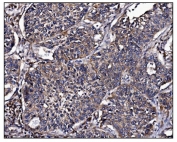 IHC staining of FFPE human lung cancer tissue with POGLUT1 antibody. HIER: boil tissue sections in pH8 EDTA for 20 min and allow to cool before testing.