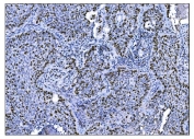 IHC staining of FFPE human lung cancer tissue with Ki67 Staining Antibody. HIER: boil tissue sections in pH8 EDTA for 20 min and allow to cool before testing.