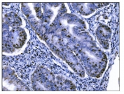 IHC staining of FFPE human cervical cancer tissue with Ki67 Staining Antibody. HIER: boil tissue sections in pH8 EDTA for 20 min and allow to cool before testing.