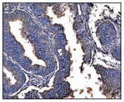 HSP90AA1 Antibody Cervical Cancer IHC. Immunohistochemistry staining of FFPE human cervical cancer tissue using HSP90AA1 Antibody / Molecular Chaperone Antibody demonstrates strong cytoplasmic HRP-DAB brown staining within malignant epithelial cells. The staining pattern is consistent with expression of HSP90AA1 (HSP90a), a highly conserved ATP-dependent molecular chaperone that regulates protein folding, stabilization of client proteins, signal transduction, and cellular stress-response pathways. HSP90AA1 supports the activity of numerous proteins involved in cellular proliferation, survival, and adaptation to physiological stress, making it an important target in cancer biology and proteostasis research. HIER was performed by boiling tissue sections in pH 8 EDTA buffer for 20 minutes followed by cooling prior to immunostaining.