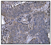 HSP90AA1 Antibody Lung Cancer IHC. Immunohistochemistry staining of FFPE human lung cancer tissue using HSP90AA1 Antibody / Molecular Chaperone Antibody demonstrates moderate cytoplasmic HRP-DAB brown staining within malignant epithelial tumor cells. The staining pattern is consistent with expression of HSP90AA1 (HSP90a), a highly conserved ATP-dependent molecular chaperone that regulates protein folding, stabilization of client proteins, signal transduction, and cellular stress-response pathways. HSP90AA1 supports the activity of numerous regulatory proteins involved in cellular proliferation, survival, and adaptation to tumor-associated stress, making it an important target in cancer biology and proteostasis research. HIER was performed by boiling tissue sections in pH 8 EDTA buffer for 20 minutes followed by cooling prior to immunostaining.