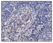 HSP90AA1 Antibody Testis Cancer IHC. Immunohistochemistry staining of FFPE human testis cancer tissue using HSP90AA1 Antibody / Molecular Chaperone Antibody demonstrates cytoplasmic HRP-DAB brown staining within malignant tumor cells. The staining pattern is consistent with expression of HSP90AA1 (HSP90a), a highly conserved ATP-dependent molecular chaperone that regulates protein folding, stabilization of client proteins, signal transduction, and cellular stress-response pathways. HSP90AA1 supports the activity of numerous proteins involved in cellular proliferation, survival, and adaptation to physiological stress, making it an important target in cancer biology, proteostasis research, and studies of tumor-associated signaling networks. HIER was performed by boiling tissue sections in pH 8 EDTA buffer for 20 minutes followed by cooling prior to immunostaining.