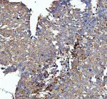 AP2A1 Antibody Human Liver Cancer IHC. Immunohistochemistry staining of FFPE human liver cancer tissue with AP2A1 Antibody at 2 ug/ml. HIER was performed using pH 8 EDTA buffer, followed by blocking with 10% goat serum. The tissue section was incubated with rabbit anti-AP2A1 antibody overnight at 4Â°C, followed by HRP-conjugated goat anti-rabbit IgG secondary antibody and DAB chromogen detection. AP2A1 Antibody / Clathrin Adaptor Protein Antibody, validated using AP2A1 knockout cells, demonstrates cytoplasmic staining and supports studies of clathrin-mediated endocytosis, vesicle trafficking and receptor internalization pathways.