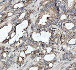 AP2A1 Antibody Human Prostate Cancer IHC. Immunohistochemistry staining of FFPE human prostatic acinar adenocarcinoma tissue with AP2A1 Antibody at 2 ug/ml. HIER was performed using pH 8 EDTA buffer, followed by blocking with 10% goat serum. The tissue section was incubated with rabbit anti-AP2A1 antibody overnight at 4Â°C, followed by HRP-conjugated goat anti-rabbit IgG secondary antibody and DAB chromogen detection. AP2A1 Antibody / Clathrin Adaptor Protein Antibody, validated using AP2A1 knockout cells, demonstrates cytoplasmic staining in prostate cancer cells and supports studies of clathrin-mediated endocytosis, vesicle trafficking and receptor internalization pathways.