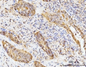 HMGCS1 Antibody Human Gallbladder Adenosquamous Carcinoma IHC. Immunohistochemical staining of FFPE human gallbladder adenosquamous carcinoma tissue using HMGCS1 Antibody / Mevalonate Pathway Enzyme Antibody demonstrates moderate to strong cytoplasmic and membranous HRP-DAB brown staining within malignant epithelial tumor cells. The staining pattern is consistent with expression of HMGCS1, a key metabolic enzyme that catalyzes an early step in the mevalonate pathway responsible for cholesterol and isoprenoid biosynthesis. Positive immunoreactivity within neoplastic cells highlights the importance of lipid metabolic pathways in supporting membrane synthesis, cellular growth, and tumor progression. The observed expression pattern supports the utility of HMGCS1 as a marker for studies of metabolic reprogramming and mevalonate pathway activity in cancer. HIER: boil tissue sections in pH8 EDTA for 20 min and allow to cool before testing.