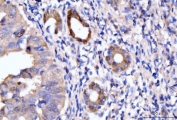 HMGCS1 Antibody Gastric Adenocarcinoma Tissue IHC. Immunohistochemical staining of FFPE human gastric adenocarcinoma tissue using HMGCS1 Antibody / Mevalonate Pathway Enzyme Antibody demonstrates distinct cytoplasmic and membranous HRP-DAB brown staining within malignant glandular epithelial cells. The staining pattern is consistent with expression of HMGCS1, a key enzyme of the mevalonate pathway responsible for the synthesis of HMG-CoA, an essential precursor for cholesterol and isoprenoid biosynthesis. Positive immunoreactivity within neoplastic gastric glands highlights the importance of metabolic pathways that support membrane biogenesis, cellular proliferation, and tumor growth. These results support the utility of HMGCS1 as a marker for studies of cholesterol metabolism and metabolic reprogramming in gastric adenocarcinoma. HIER: boil tissue sections in pH8 EDTA for 20 min and allow to cool before testing.