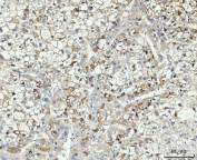 HMGCS1 Antibody Human Liver Cancer IHC. Immunohistochemical staining of FFPE human liver cancer tissue using HMGCS1 Antibody / Mevalonate Pathway Enzyme Antibody demonstrates widespread cytoplasmic and membranous HRP-DAB brown staining throughout malignant hepatocyte-like tumor cells. The staining pattern is consistent with expression of HMGCS1, a key enzyme that catalyzes an early step in the mevalonate pathway and supports cholesterol and isoprenoid biosynthesis. Strong HMGCS1 immunoreactivity within the neoplastic cell population highlights the importance of lipid metabolism and metabolic reprogramming in liver cancer biology. The observed expression pattern supports the utility of HMGCS1 as a marker for studies of cholesterol biosynthesis, cellular proliferation, and mevalonate pathway activity in hepatic malignancies. HIER: boil tissue sections in pH8 EDTA for 20 min and allow to cool before testing.