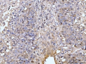 HMGCS1 Antibody Hepatocellular Carcinoma IHC. Immunohistochemical staining of FFPE human liver cancer tissue using HMGCS1 Antibody / Mevalonate Pathway Enzyme Antibody demonstrates moderate cytoplasmic and membranous HRP-DAB brown staining within malignant hepatocyte-like tumor cells. The staining pattern is consistent with expression of HMGCS1, a key enzyme of the mevalonate pathway responsible for the synthesis of HMG-CoA, an essential precursor for cholesterol and isoprenoid biosynthesis. Positive immunoreactivity is observed throughout neoplastic cell populations and supports the role of HMGCS1 in metabolic pathways that contribute to membrane synthesis, cellular growth, and tumor progression. These results demonstrate the utility of HMGCS1 as a marker for studies of cholesterol metabolism and metabolic reprogramming in hepatocellular malignancies. HIER: boil tissue sections in pH8 EDTA for 20 min and allow to cool before testing.