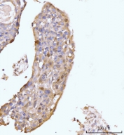 HMGCS1 Antibody Esophageal Squamous Carcinoma IHC. Immunohistochemical staining of FFPE human esophageal squamous carcinoma tissue using HMGCS1 Antibody / Mevalonate Pathway Enzyme Antibody demonstrates moderate cytoplasmic and membranous HRP-DAB brown staining within malignant squamous epithelial cells. The staining pattern is consistent with expression of HMGCS1, a key enzyme of the mevalonate pathway that catalyzes an early step in cholesterol and isoprenoid biosynthesis. Positive immunoreactivity within the neoplastic cell population highlights the importance of lipid metabolic pathways that support membrane production, cellular proliferation, and tumor growth. These findings support the utility of HMGCS1 as a marker for studies of metabolic reprogramming and mevalonate pathway activity in esophageal squamous cell carcinoma. HIER: boil tissue sections in pH8 EDTA for 20 min and allow to cool before testing.