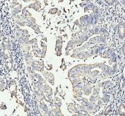 IHC staining of FFPE human gastric adenocarcinoma tissue with MOV10 antibody. HIER: boil tissue sections in pH8 EDTA for 20 min and allow to cool before testing.