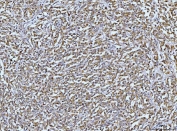 DUSP6 Antibody Human Lymphadenoma IHC. Immunohistochemical staining of FFPE human lymphadenoma tissue using DUSP6 antibody demonstrates widespread cytoplasmic HRP-DAB brown staining throughout neoplastic lymphoid cell populations. The staining pattern is consistent with expression of DUSP6, a dual-specificity phosphatase that functions as a key negative regulator of ERK/MAPK signaling pathways. By controlling the phosphorylation state of ERK proteins, DUSP6 helps modulate signaling networks involved in cellular proliferation, differentiation, survival, and responses to growth factor stimulation. The observed staining supports the role of DUSP6 in regulating intracellular signaling pathways that influence cellular homeostasis and tissue biology. HIER: boil tissue sections in pH 8 EDTA for 20 minutes and allow to cool before testing.