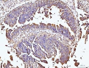 DUSP6 Antibody Human Colonic Adenocarcinoma IHC. Immunohistochemical staining of FFPE human colonic adenocarcinoma tissue using DUSP6 antibody demonstrates moderate to strong cytoplasmic HRP-DAB brown staining within neoplastic gland-forming epithelial cells. The staining pattern is consistent with expression of DUSP6, a dual-specificity phosphatase that functions as a key negative regulator of ERK/MAPK signaling pathways. DUSP6 modulates cellular responses to growth factor stimulation by controlling ERK phosphorylation and signaling duration, thereby influencing pathways associated with cellular proliferation, differentiation, and survival. The observed staining within tumor epithelial structures supports the role of DUSP6 in regulating intracellular signaling networks that contribute to tissue homeostasis and cellular growth control. HIER: boil tissue sections in pH 8 EDTA for 20 minutes and allow to cool before testing.