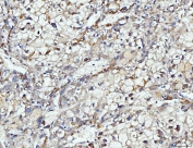 DUSP6 Antibody Human Liver Cancer IHC. Immunohistochemical staining of FFPE human liver cancer tissue using DUSP6 antibody demonstrates moderate membranous and cytoplasmic HRP-DAB brown staining within neoplastic hepatic cell populations. The staining pattern is consistent with expression of DUSP6, a dual-specificity phosphatase that functions as a key negative regulator of ERK/MAPK signaling pathways. DUSP6 modulates cellular responses to growth factor stimulation by controlling ERK phosphorylation and signaling duration, thereby influencing pathways associated with cellular proliferation, differentiation, survival, and tissue homeostasis. The observed expression within tumor cells supports the role of DUSP6 in regulating intracellular signaling networks that govern cellular growth and signal transduction. HIER: boil tissue sections in pH 8 EDTA for 20 minutes and allow to cool before testing.