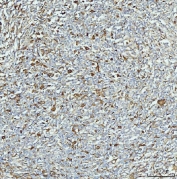 Aldehyde Dehydrogenase 1A1 Antibody Lymphadenoma IHC. Immunohistochemistry staining of FFPE human lymphadenoma tissue with Aldehyde Dehydrogenase 1A1 antibody. HIER: boil tissue sections in pH8 EDTA for 20 min and allow to cool before testing.