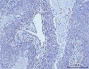 IHC staining of FFPE human liver cancer tissue with CD93 antibody. HIER: boil tissue sections in pH8 EDTA for 20 min and allow to cool before testing.
