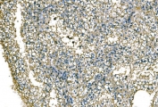 NEDD4 Antibody Renal Cell Carcinoma IHC Tumor Tissue. Immunohistochemistry analysis of Neural precursor cell expressed developmentally down-regulated protein 4 / NEDD4 in FFPE human renal cell carcinoma tissue using NEDD4 Antibody for IHC. HRP-DAB brown chromogenic staining demonstrates cytoplasmic and membrane-associated localization in tumor epithelial cells, with variable intensity across the tumor field, while surrounding stromal regions show comparatively reduced signal. The staining pattern highlights tumor cell architecture and supports evaluation of NEDD4 expression within the tumor microenvironment. HIER: boil tissue sections in pH8 EDTA for 20 min and allow to cool before testing.