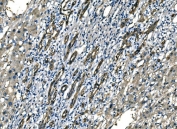 NEDD4 Antibody Liver Cancer IHC Tumor Tissue. Immunohistochemistry analysis of Neural precursor cell expressed developmentally down-regulated protein 4 / NEDD4 in FFPE human liver cancer tissue using NEDD4 Antibody for IHC. HRP-DAB brown chromogenic staining demonstrates cytoplasmic and membrane-associated localization in tumor epithelial cells, with heterogeneous staining intensity across tumor regions and reduced signal in surrounding stromal compartments. The staining pattern highlights tumor cell morphology and supports evaluation of NEDD4 expression within hepatic tumor tissue. HIER: boil tissue sections in pH8 EDTA for 20 min and allow to cool before testing.