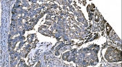 NEDD4 Antibody Colon Adenocarcinoma IHC Tumor Architecture. Immunohistochemistry analysis of Neural precursor cell expressed developmentally down-regulated protein 4 / NEDD4 in FFPE human colon adenocarcinoma tissue using NEDD4 Antibody for IHC. HRP-DAB brown chromogenic staining demonstrates cytoplasmic and membrane-associated localization in gland-forming tumor epithelial cells, with variable staining intensity across malignant glands and reduced signal in stromal regions. The staining pattern highlights glandular tumor architecture and supports evaluation of NEDD4 expression in colorectal carcinoma tissue. HIER: boil tissue sections in pH8 EDTA for 20 min and allow to cool before testing.