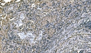 NEDD4 Antibody Lung Cancer IHC Tumor Tissue Analysis. Immunohistochemistry analysis of Neural precursor cell expressed developmentally down-regulated protein 4 / NEDD4 in FFPE human lung cancer tissue using NEDD4 Antibody for IHC. HRP-DAB brown chromogenic staining demonstrates cytoplasmic and membrane-associated localization in tumor epithelial cells, with heterogeneous staining across tumor regions and reduced signal in surrounding stromal areas. The staining pattern highlights tumor architecture and supports evaluation of NEDD4 expression within lung carcinoma tissue. HIER: boil tissue sections in pH8 EDTA for 20 min and allow to cool before testing.