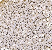 IHC staining of FFPE human liver cancer tissue with H1F0 antibody. HIER: boil tissue sections in pH8 EDTA for 20 min and allow to cool before testing.