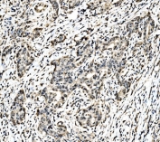 c-Jun Antibody Renal Pelvis Squamous Metaplasia IHC. Immunohistochemical staining of FFPE human renal pelvis squamous metaplasia tissue using c-Jun Antibody demonstrates predominantly nuclear HRP-DAB brown staining within metaplastic epithelial cell populations. The staining pattern is consistent with expression of c-Jun (JUN), a DNA-binding transcription factor that functions as a key regulator of gene expression downstream of AP-1 signaling pathways. As a transcriptional regulation protein, c-Jun participates in cellular differentiation, stress responses, tissue remodeling, and signal transduction processes. Nuclear localization of c-Jun supports its role in controlling transcriptional programs associated with epithelial adaptation and phenotypic change. HIER: boil tissue sections in pH 8 EDTA buffer for 20 minutes and allow to cool before testing.