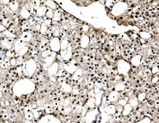 c-Jun Antibody Renal Cell Carcinoma IHC. Immunohistochemical staining of FFPE human renal cell carcinoma tissue using c-Jun Antibody demonstrates prominent nuclear HRP-DAB brown staining throughout neoplastic cell populations. The staining pattern is consistent with expression of c-Jun (JUN), a DNA-binding transcription factor and key regulator of gene expression downstream of AP-1 signaling pathways. As a transcriptional regulation protein, c-Jun influences cellular proliferation, differentiation, stress responses, and tumor-associated signaling networks. The predominantly nuclear localization observed in tumor cells is consistent with the established role of c-Jun in controlling transcriptional programs that govern cellular adaptation and gene expression. HIER: boil tissue sections in pH 8 EDTA buffer for 20 minutes and allow to cool before testing.