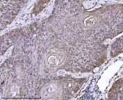 IHC staining of FFPE human squamous cell lung carcinoma tissue with ERLIN2 antibody. HIER: boil tissue sections in pH8 EDTA for 20 min and allow to cool before testing.