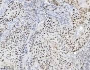 MCM7 Antibody Laryngeal Squamous Cell Carcinoma IHC. Immunohistochemistry staining of FFPE human laryngeal squamous cell carcinoma tissue with MCM7 antibody. HIER: boil tissue sections in pH8 EDTA for 20 min and allow to cool before testing.