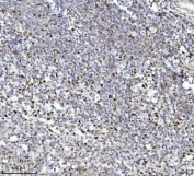 MCM7 Antibody Chronic Tonsillitis Tissue IHC. Immunohistochemistry staining of FFPE human chronic tonsillitis tissue with MCM7 antibody. HIER: boil tissue sections in pH8 EDTA for 20 min and allow to cool before testing.