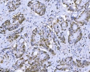 MCM7 Antibody Adenocarcinoma of the Colon Tissue IHC. Immunohistochemistry staining of FFPE human adenocarcinoma of the colon tissue with MCM7 antibody. HIER: boil tissue sections in pH8 EDTA for 20 min and allow to cool before testing.