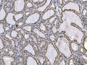 IHC staining of FFPE human thyroiditis tissue with Ataxin 1 antibody. HIER: boil tissue sections in pH8 EDTA for 20 min and allow to cool before testing.