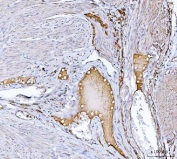 Clusterin Antibody Endometrial Cancer IHC. Immunohistochemistry staining of FFPE human endometrial cancer tissue with Clusterin antibody. HIER: boil tissue sections in pH8 EDTA for 20 min and allow to cool before testing.