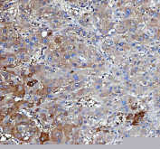 IHC staining of FFPE human liver cancer tissue with Insulin receptor substrate 2 antibody. HIER: boil tissue sections in pH8 EDTA for 20 min and allow to cool before testing.