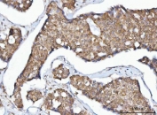IHC staining of FFPE human breast cancer tissue with Mitochondrial fission factor antibody. HIER: boil tissue sections in pH8 EDTA for 20 min and allow to cool before testing.