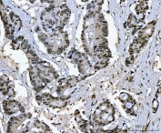 Ki-67 Rabbit Polyclonal IHC Antibody / MKI67 Immunohistochemistry Antibody. Immunohistochemistry analysis of FFPE human colonic adenocarcinoma tissue using Ki-67 rabbit polyclonal IHC antibody. Prominent nuclear brown staining is observed in many tumor epithelial cells lining the malignant glandular structures, consistent with the known expression pattern of Ki-67 / MKI67 in actively proliferating cells. The staining highlights proliferating carcinoma cells within the tumor glands while surrounding stromal tissue shows comparatively lower labeling. Heat-induced epitope retrieval was performed by boiling tissue sections in pH8 EDTA buffer for 20 minutes followed by cooling prior to staining.