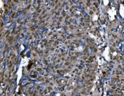 IHC staining of FFPE human lung cancer tissue with Ki-67 IHC antibody. HIER: boil tissue sections in pH8 EDTA for 20 min and allow to cool before testing.