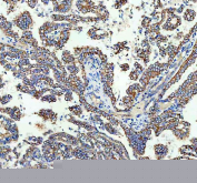 IHC staining of FFPE human lung cancer tissue with TOMM20 antibody. HIER: boil tissue sections in pH8 EDTA for 20 min and allow to cool before testing.