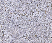 von Willebrand Factor Antibody / Hemostasis Research Antibody. Immunohistochemistry analysis of human renal cancer tissue shows HRP-DAB brown staining of endothelial cells forming an extensive network of vascular channels throughout the tumor microenvironment. The staining outlines numerous thin, branching vessel structures distributed between tumor cell clusters, with signal localized along endothelial surfaces consistent with VWF presence at the vascular interface. This pattern reflects widespread vascular involvement associated with platelet interaction and coagulation factor support within neoplastic tissue. Endothelial-lined vessels are clearly distinguished from surrounding tumor cells and stromal components. HIER: boil tissue sections in pH8 EDTA for 20 min and allow to cool before testing.