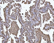 IHC staining of FFPE human lung cancer tissue with ECHS1 antibody. HIER: boil tissue sections in pH8 EDTA for 20 min and allow to cool before testing.