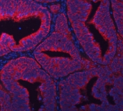 Immunofluorescent staining of FFPE human endometrial cancer tissue with RPL36 antibody (red) and DAPI nuclear stain (blue). HIER: steam section in pH8 EDTA buffer for 20 min.