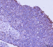 IHC staining of FFPE human esophageal squamous carcinoma tissue with Transcription factor EB antibody. HIER: boil tissue sections in pH8 EDTA for 20 min and allow to cool before testing.
