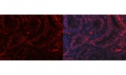 Immunofluorescent staining of FFPE human intestinal cancer tissue with PC4 antibody (red) and DAPI nuclear stain (blue). HIER: steam section in pH8 EDTA buffer for 20 min.