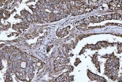 HBEGF Antibody Lung Adenocarcinoma IHC. Immunohistochemistry analysis of FFPE human lung adenocarcinoma tissue stained with HBEGF antibody detecting Heparin-binding EGF-like growth factor (DT-R). Tumor epithelial cells show membranous and cytoplasmic staining, consistent with localization of HBEGF as a cell surface receptor involved in diphtheria toxin binding and receptor-mediated internalization, as well as EGFR ligand signaling. The staining highlights glandular tumor architecture, while surrounding stromal elements show comparatively reduced signal. Hematoxylin counterstain highlights nuclei in blue. HIER: boil tissue sections in pH 8 EDTA for 20 min and allow to cool before testing.